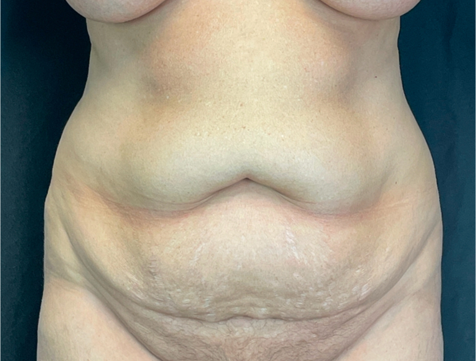 Abdominoplasty Before & After Image