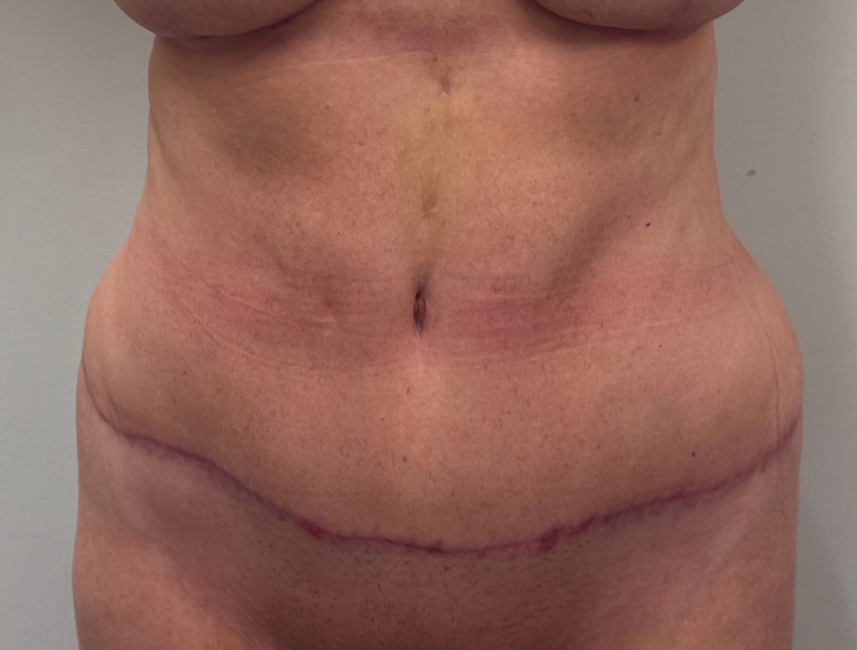 Abdominoplasty Before & After Image