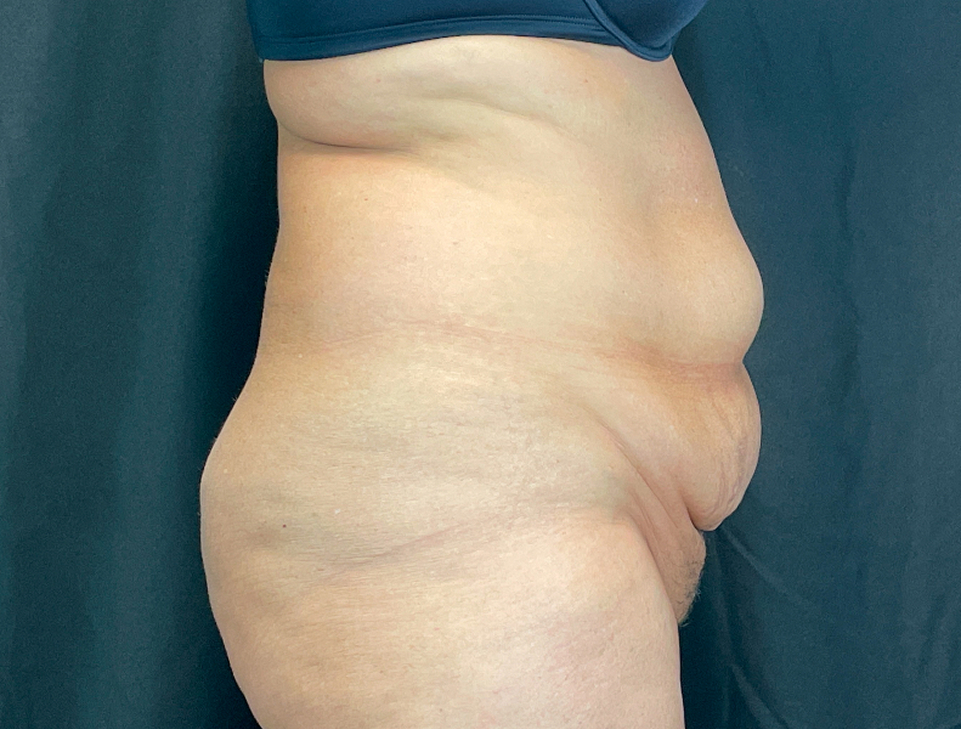 Abdominoplasty Before & After Image