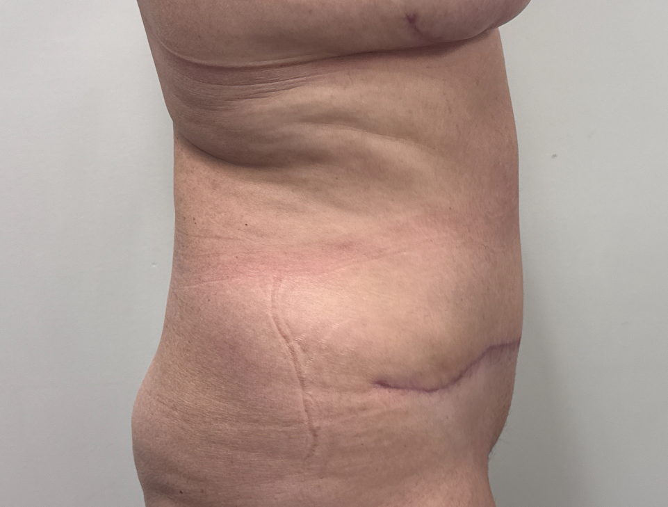 Abdominoplasty Before & After Image