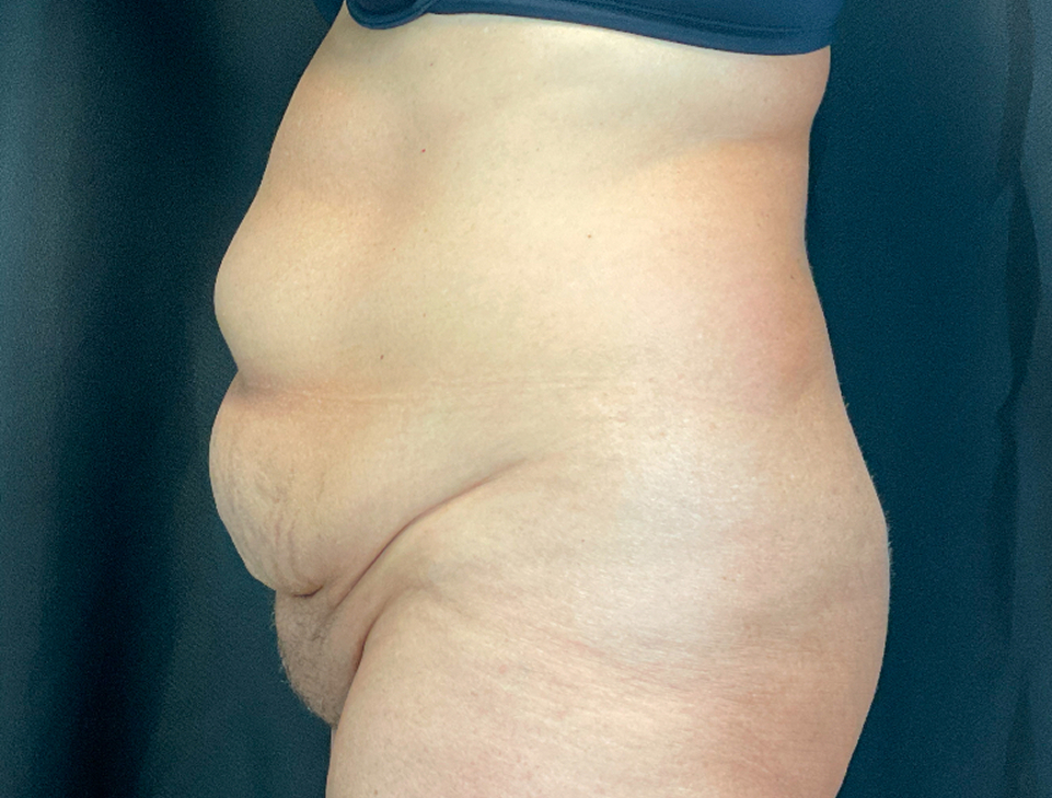 Abdominoplasty Before & After Image