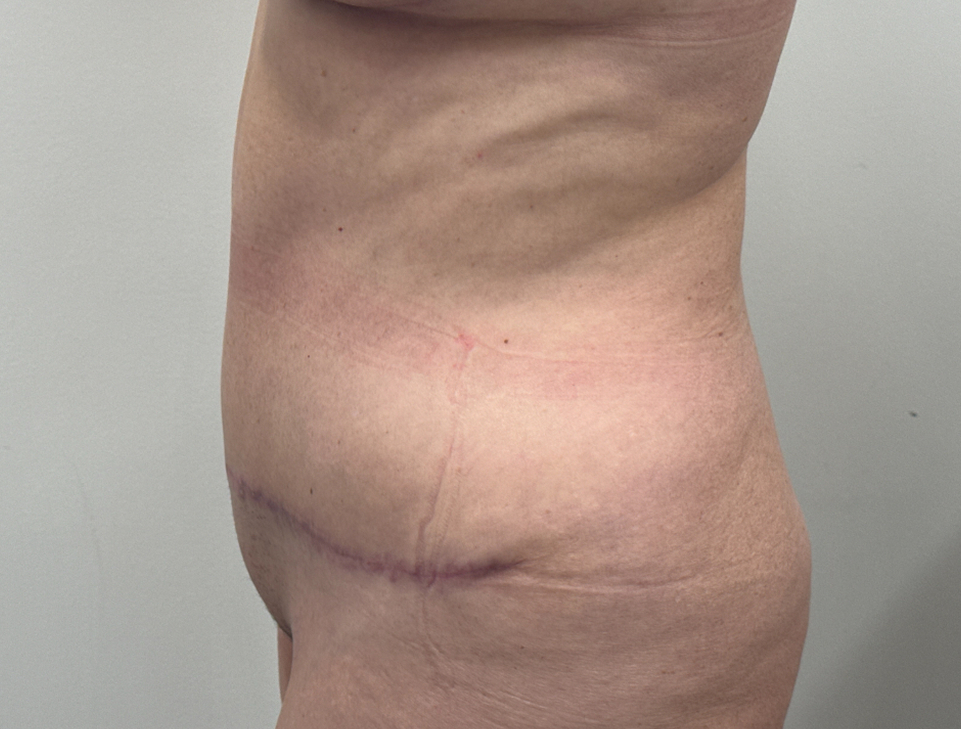 Abdominoplasty Before & After Image