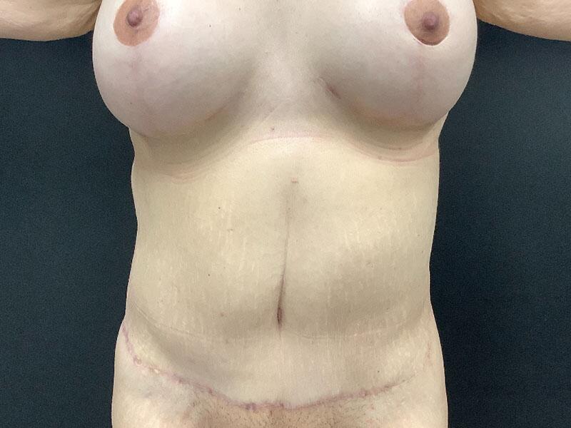 Post Bariatric Body Contouring Before & After Image