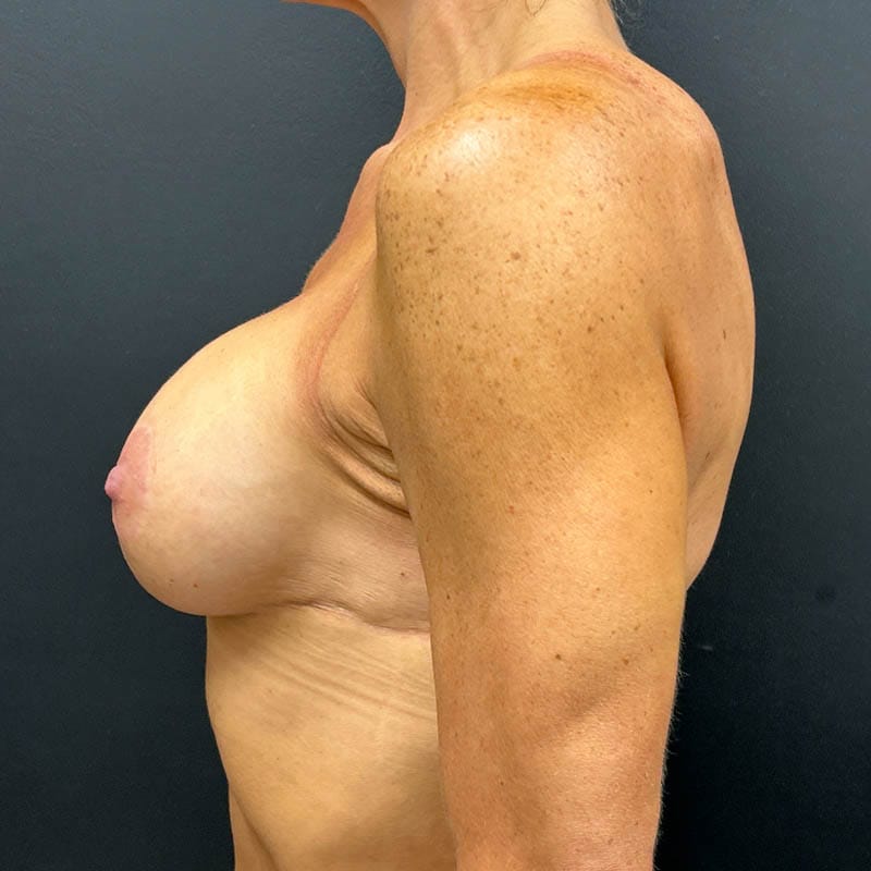 Breast Augmentation Lift Before & After Image