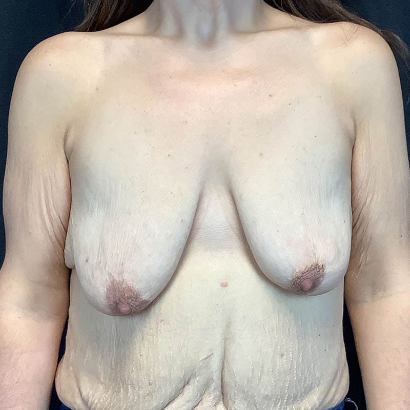 Breast Augmentation Lift Before & After Image