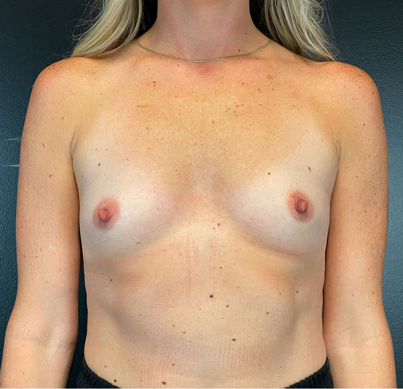 Breast Augmentation Before & After Image