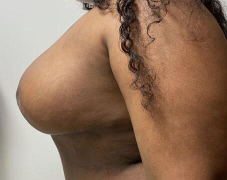 Breast Reduction Before & After Image