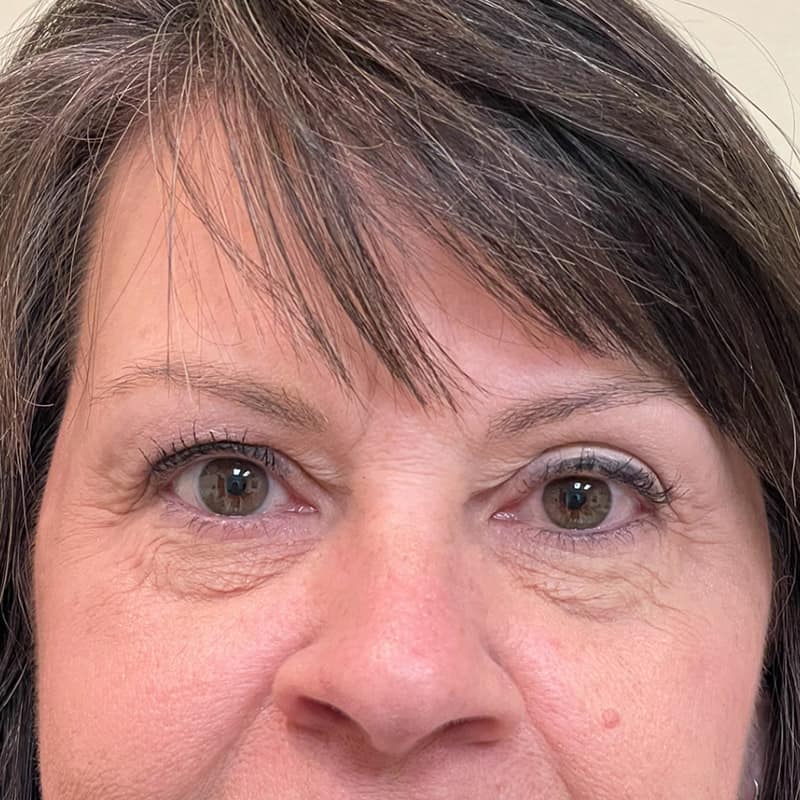 Blepharoplasty Before & After Image