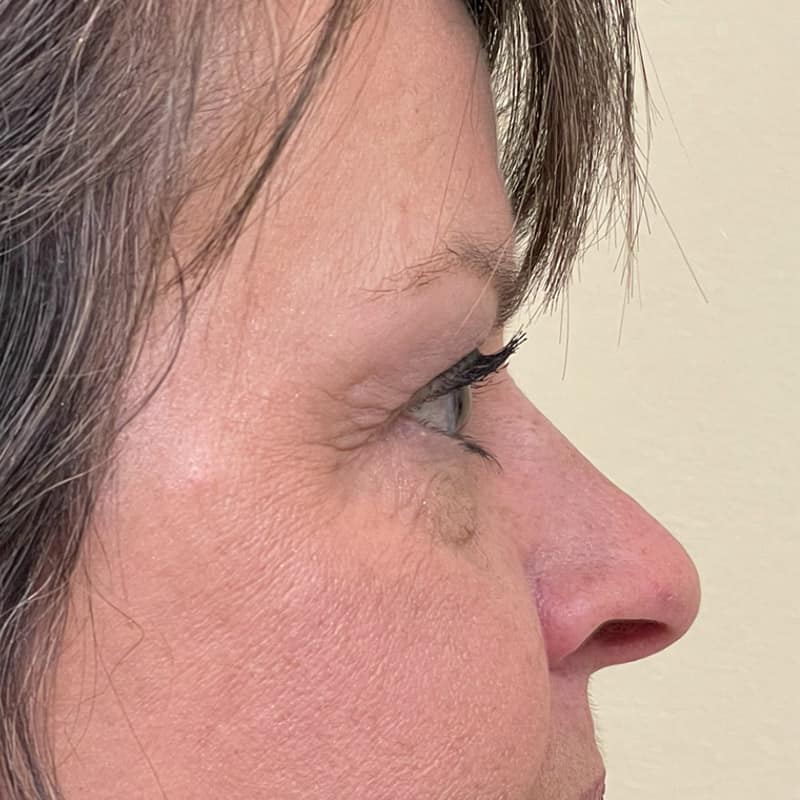 Blepharoplasty Before & After Image